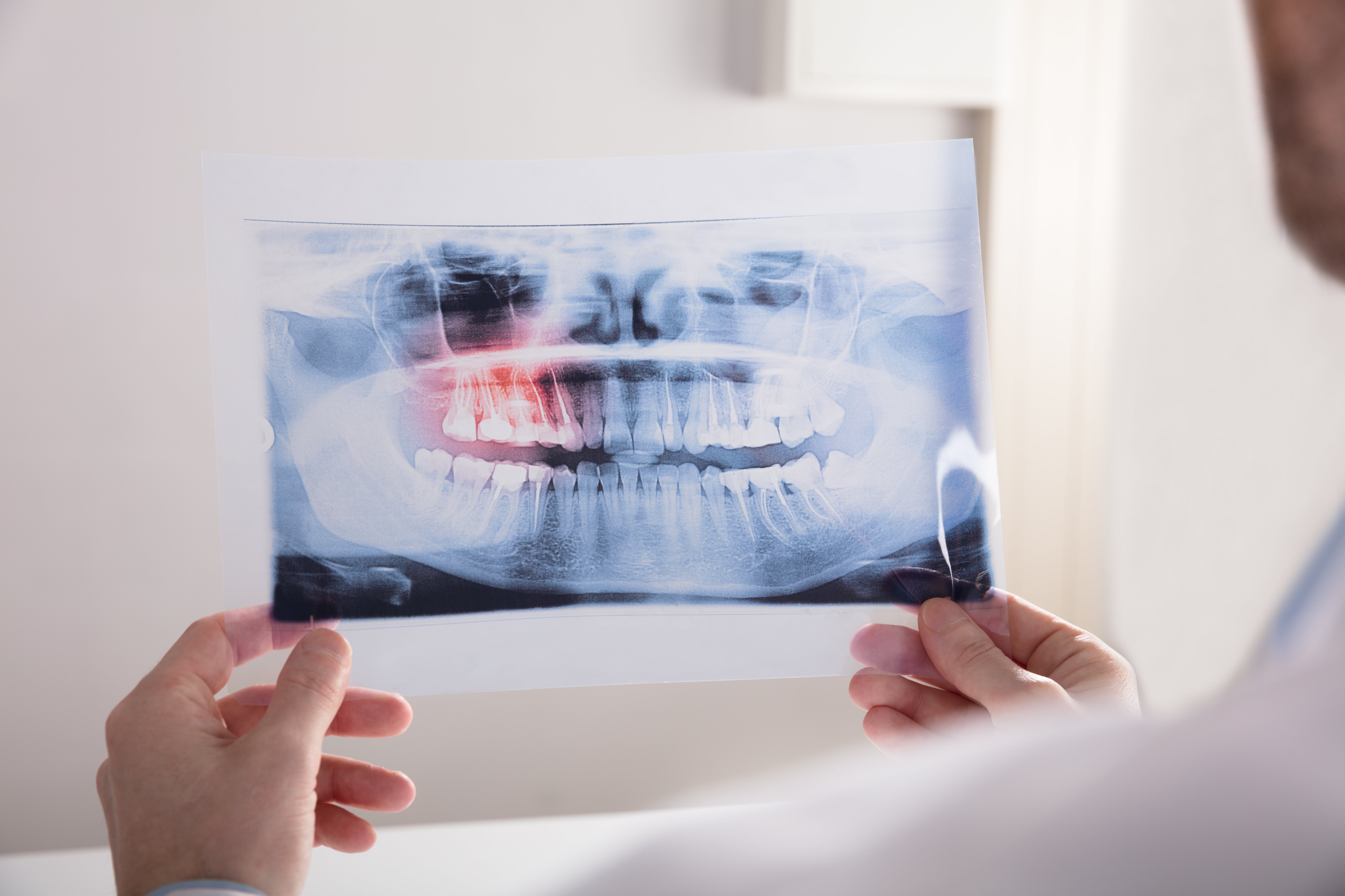 two hands holding a dental x-ray on either side of the x-ray film