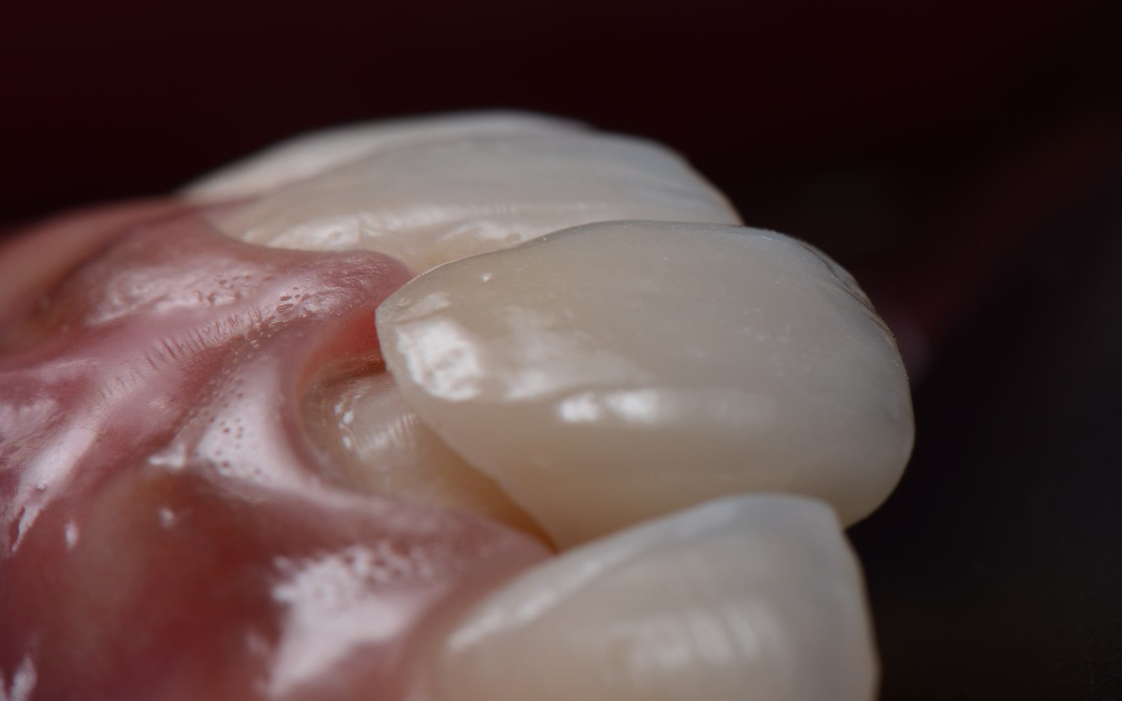Orthodontic Bonding