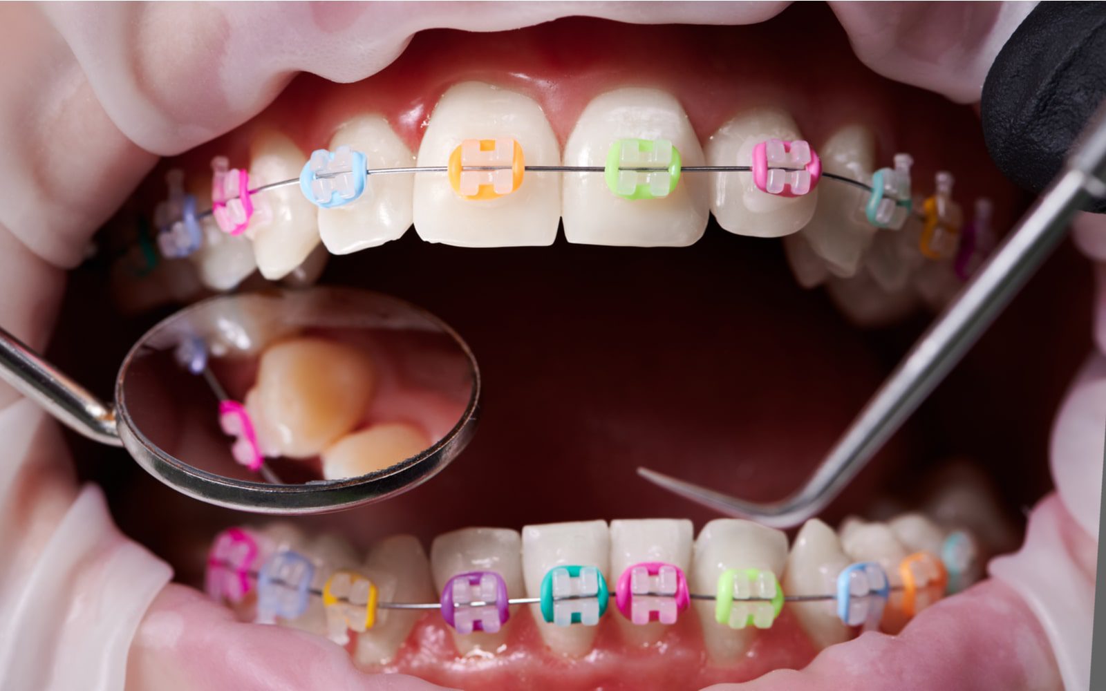 Colorful Braces During Checkup